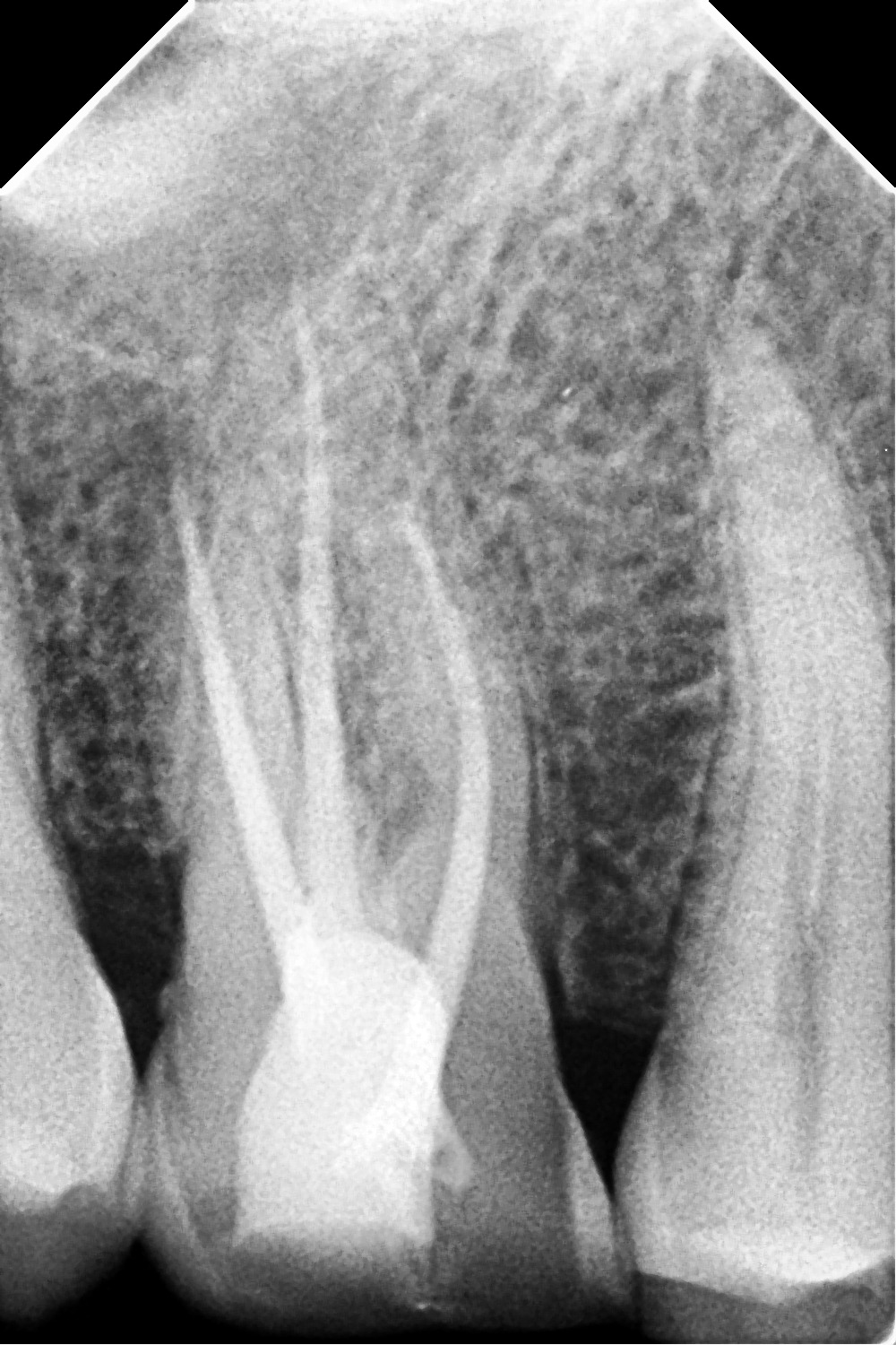 Shanthi Dental Care - Precision Anterior Root Canal Obturation Radiograph