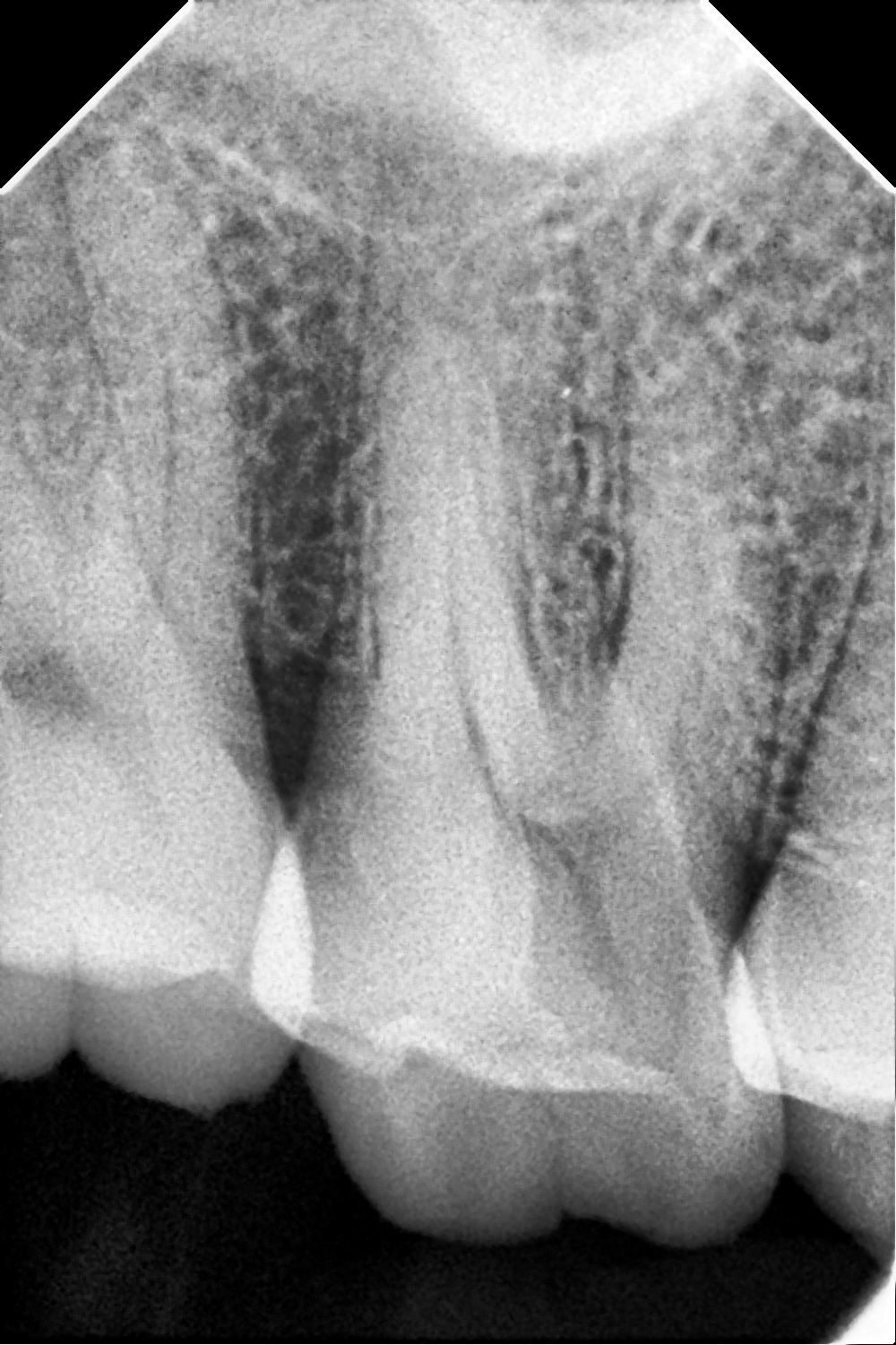 Shanthi Dental Care - Periapical Endodontic Diagnostic Assessment Radiograph