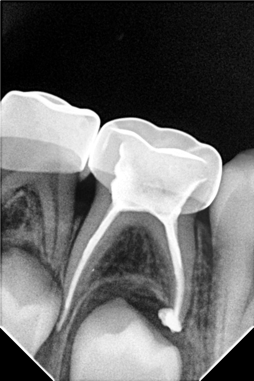 Shanthi Dental Care - Endodontic Root Canal & Multi-Root Restoration Radiograph