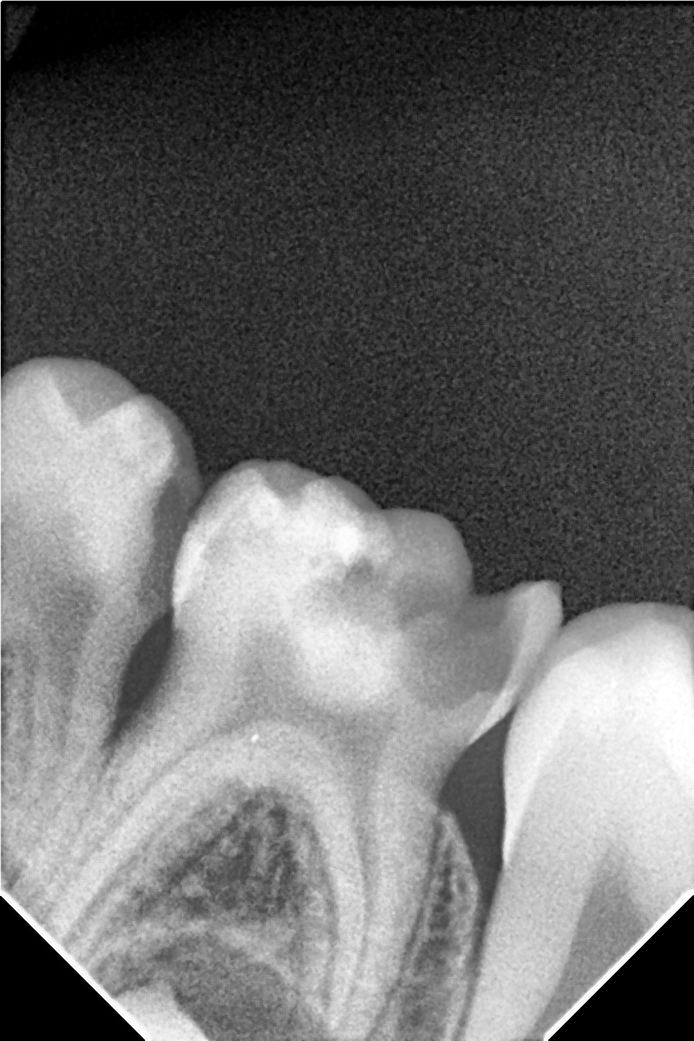 Shanthi Dental Care - High-Resolution Pulpal Pathology Diagnostics Radiograph