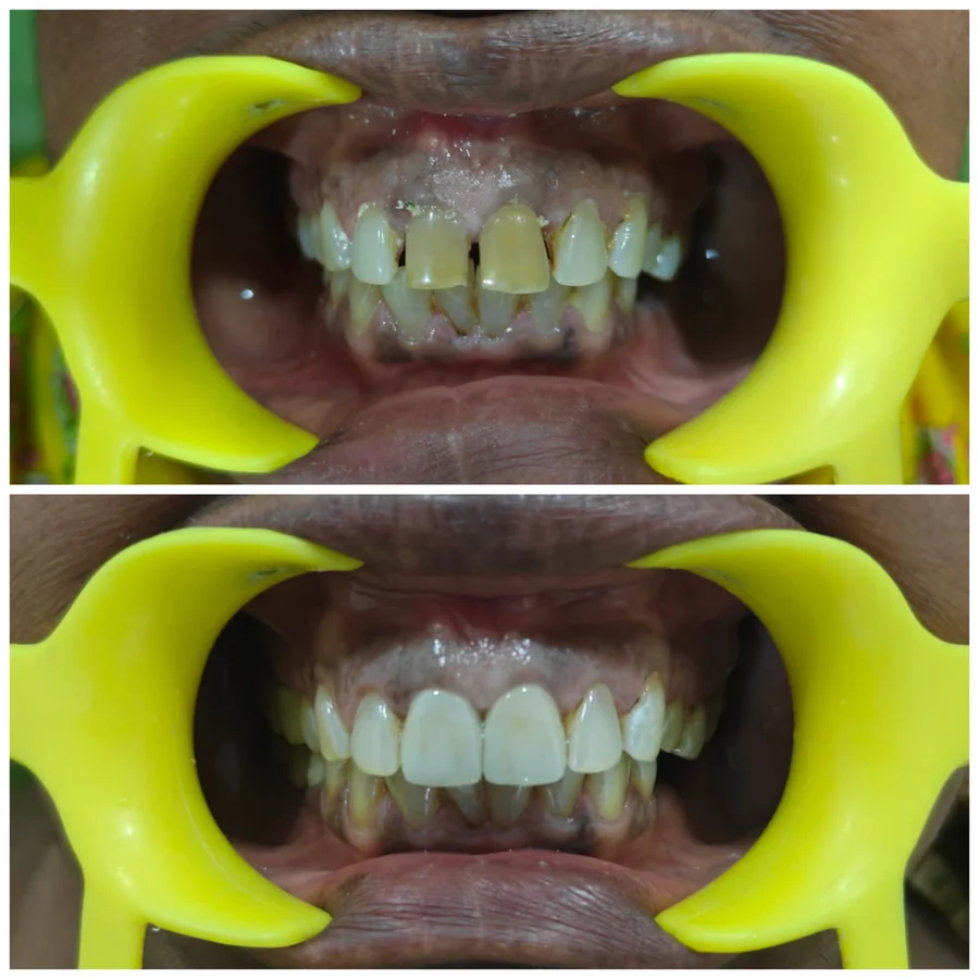 Shanthi Dental Care - Aesthetic Crown & Bridge Restoration