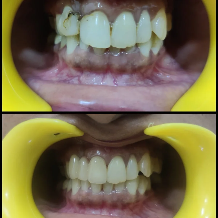 Shanthi Dental Care - Anterior Cosmetic Rehabilitation