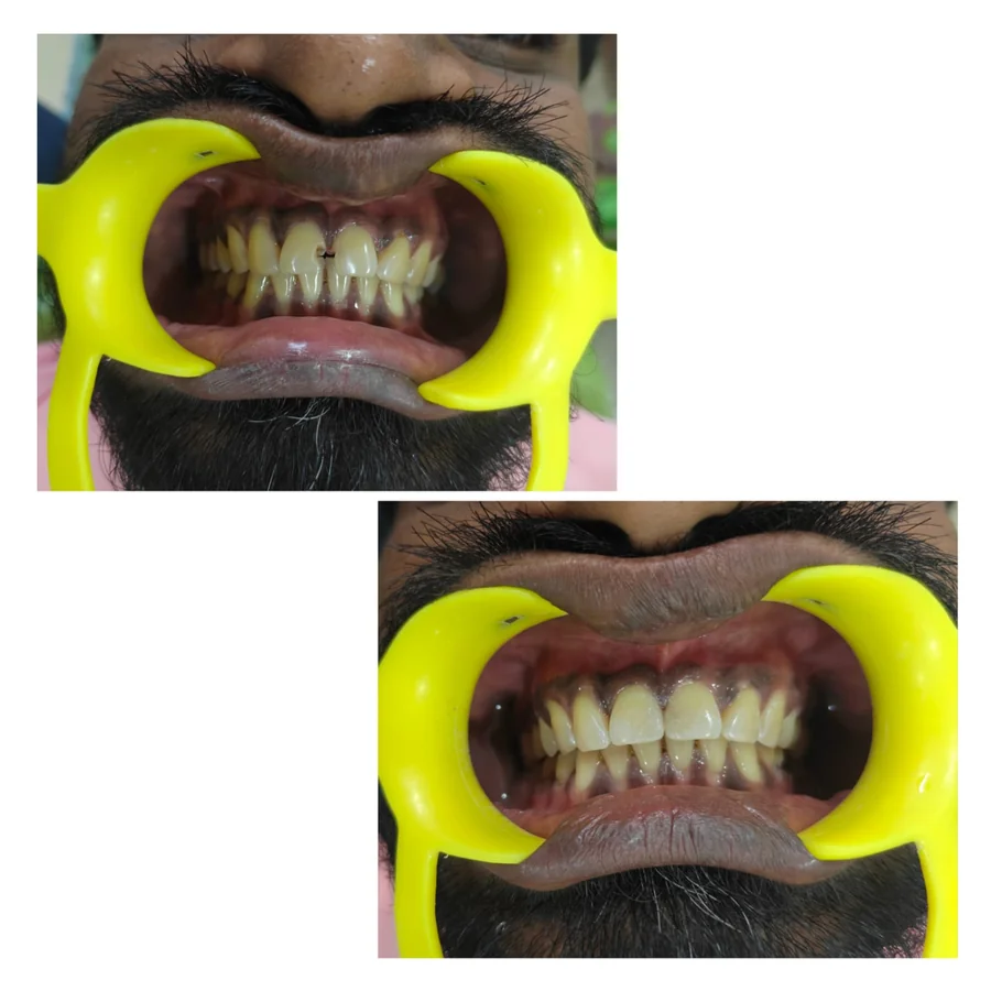 Shanthi Dental Care - Endodontic & Structural Tooth Rescue