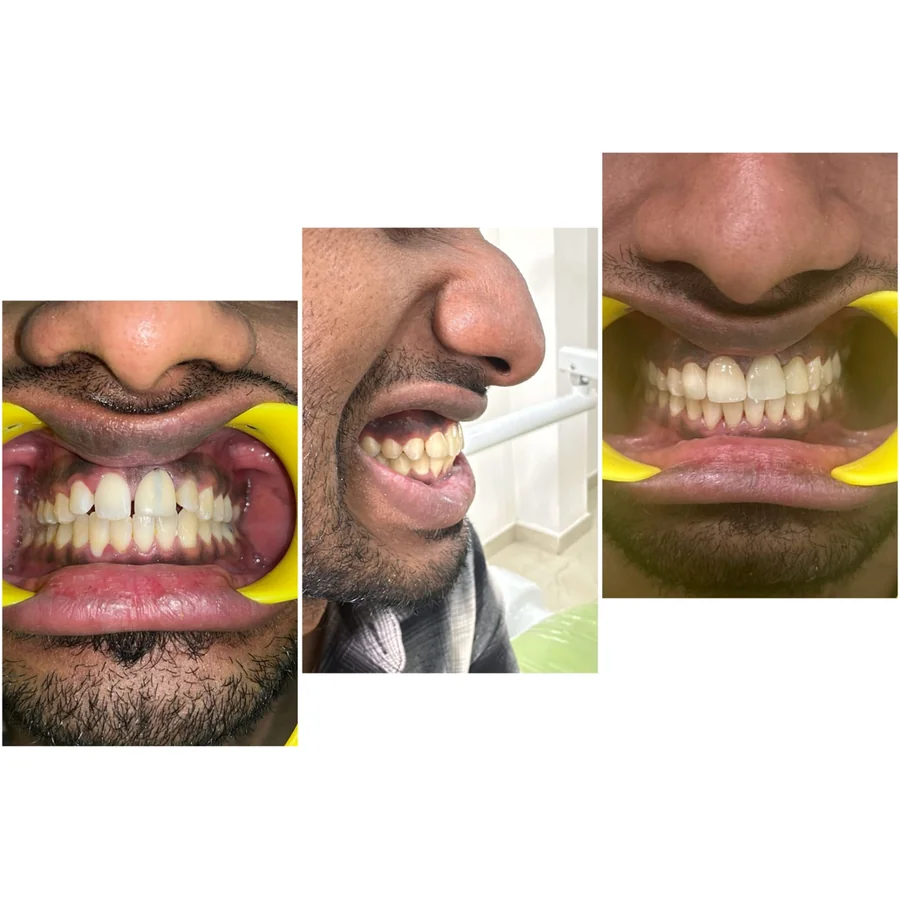 Shanthi Dental Care - Full Arch Restorative & Smile Design