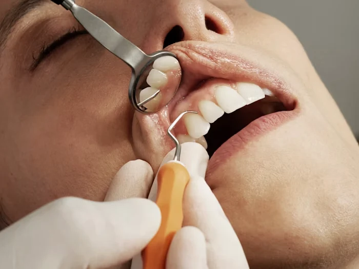 Teeth Cleaning
