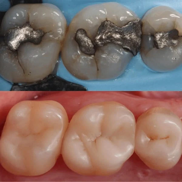 Tooth Coloured Fillings