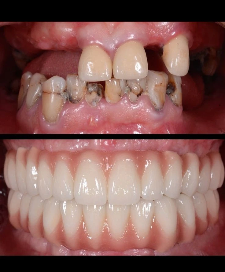 Full Mouth Rehabilitation
