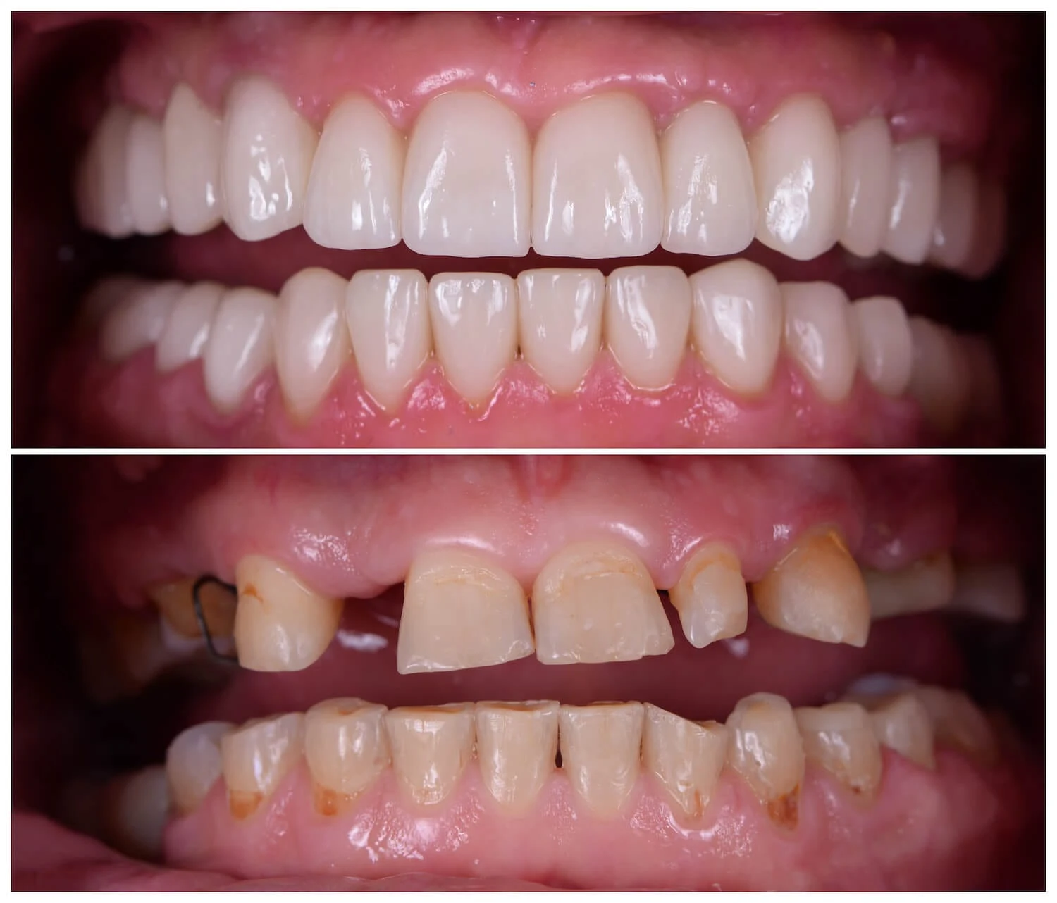 Smile Designing